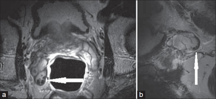 29-year-old male presented with hematospermia. a) Axial T2-weighted and b) sagittal T2-weighted MRI through the right SV show punctate foci of low signal along the periphery of the SV (white arrow), consistent with calculi.