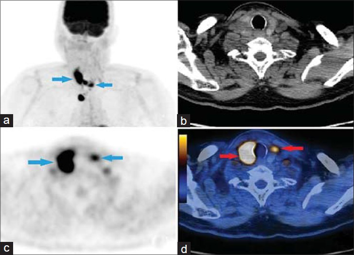 Case 2. 66-year-old male complaining of a mass in the neck was diagnosed with supraglottic squamous cell carcinoma. a) Maximum Intensity Projection (MIP) image shows supraglottic SCC metastasis in both lobes of the thyroid gland (arrows). b) CT image for attenuation correction and anatomic localization. c) Axial PET image shows intense metabolic activity in both lobes (arrows). d) Axial PET/CT fusion image reveals SUVmax of the right thyroid lobe was 20.3 and SUVmax of the left lobe was 7 (arrows).