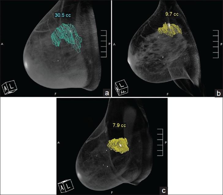 48-year-old woman diagnosed with invasive ductal carcinoma. Radiologist segmented the tumor from multiple coronal images. Volume-rendered (3-D) breast CT images show the tumor volume obtained at (a) pre-treatment, (b) mid-treatment, and (c) post-treatment.