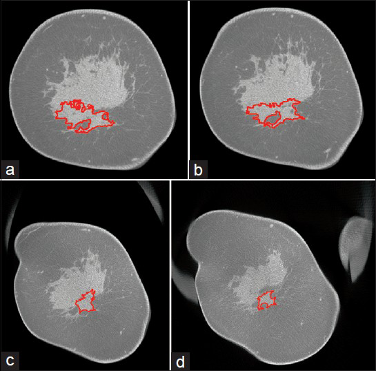 41-year-old woman diagnosed with invasive ductal carcinoma at 6-o’clock position. (a–d) Cross-sectional (coronal) slices from post-treatment bCT exam performed prior to surgery show the contour (red) of the tumor segmented using the developed algorithm. The slices progress from the nipple toward the chest wall. The largest tumor dimension (size) was estimated over all sagittal planes that correspond to the manner in which the surgical specimen is sectioned by pathology. Tumor size determined using the algorithm was 2.82 cm. Pathology reported tumor size of 3 cm.