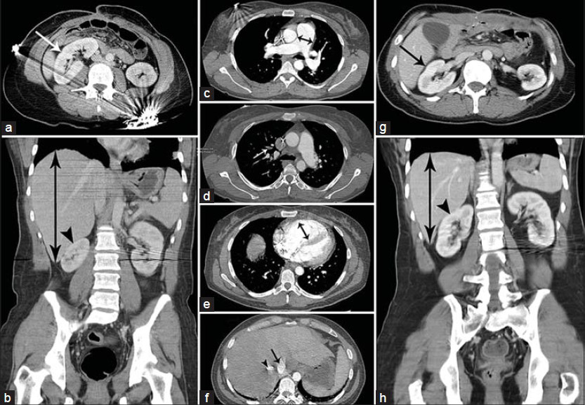 43-year-old woman presented with recurrent enterocutaneous fistula and synchronous acute pulmonary embolism, and was subsequently noted to have acquired, transient, rotated right kidney. (a) Axial contrast-enhanced computed tomography (CECT) scan of the abdomen at presentation (Day 0) shows rotation of the enlarged right kidney (arrow) around its short axis into the horizontal plane. (b) Coronal CECT scan of the abdomen at Day 0 shows hepatomegaly (double head arrow) with rotation of the enlarged right kidney (arrow head) around its short axis into the horizontal plane. (c) Axial CECT scan of the chest at Day 0 shows enlarged main pulmonary artery (double head arrow) measuring 34 mm. (d) Axial CECT scan of the chest at Day 0 shows segmental embolus (arrow) in the anterior branch of the right upper lobe pulmonary artery. (e) Axial CECT scan of the chest at Day 0 shows dilated right ventricle (double head arrow) with RV/LV ratio of 1.8. (f) Axial CECT scan of the liver at day 0 shows reflux of the contrast material into the inferior vena cava (arrow) and hepatic veins (arrow head). (g) Axial CECT scan of the abdomen 45 days before presentation (day –45) shows normal orientation of the normal-sized right kidney (arrow). (h) Coronal CECT scan of the abdomen at Day -45 shows normal orientation of the normal-sized right kidney (arrow head) and normal liver (double head arrow) size.