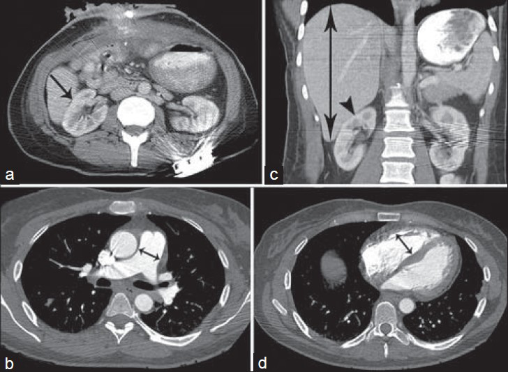 43-year-old woman presented with recurrent enterocutaneous fistula and synchronous acute pulmonary embolism, and was subsequently noted to have acquired, transient, rotated right kidney. (a) Axial contrast-enhanced computed tomography (CECT) scan of the abdomen 10 days after presentation (Day 10) shows return of the right kidney (arrow) to its normal axis. (b) Axial CECT scan of the chest at Day 10 shows normal-sized main pulmonary artery (double head arrow) measuring 25 mm. (c) Coronal CECT scan of the abdomen at Day 10 shows improvement in hepatomegaly (double head arrow) with return of the right kidney (arrow head) to its normal axis. (d) CECT scan of the chest at Day 10 shows normal-sized right ventricle (double head arrow) with RV/LV ratio of 0.86.