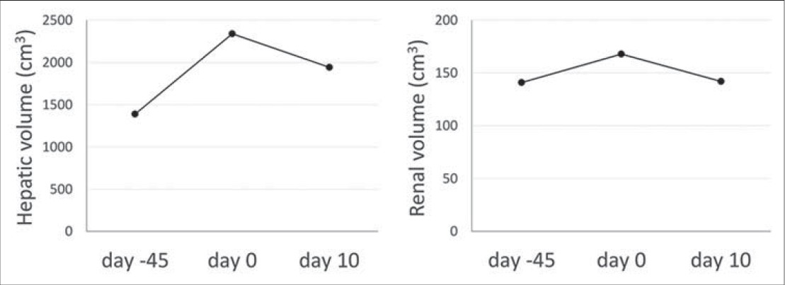 43-year-old woman presented with recurrent enterocutaneous fistula and synchronous acute pulmonary embolism, and was subsequently noted to have acquired, transient, rotated right kidney. Liver and kidney volumes were calculated 45 days before presentation (Day –45), at presentation (Day 0), and 10 days after presentation (Day 10). The volume of the liver was approximately 1390, 2340, and 1944 cm3 on Days –45, 0, and 10, respectively. The corresponding values for the right kidney were 141, 168, and 142 cm3, respectively.