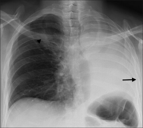 57-year-old man presenting with dyspnea and black-colored sputum diagnosed with endobronchial metastasis from melanoma. Posteroanterior chest radiograph demonstrates complete collapse of left lung, pathologic fracture of left sixth rib (arrow), and destructive mass (arrowhead) involving the right posterior fifth rib.