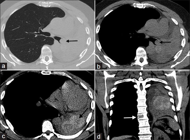 57-year-old man presenting with dyspnea and black-colored sputum diagnosed with endobronchial metastasis from melanoma. Non-enhanced CT of the chest. Axial CT images at a mid level in the chest in (a) lung window and (b) soft tissue window show a hyperdense mass (arrow) in the left main bronchus with postobstructive collapse and leftward mediastinal shift. (c) Axial CT image of a lower level in the chest demonstrates an additional hyperdense lobulated left lower lobe mass (arrow). (d) Coronal CT image shows a lytic lesion in a thoracic vertebra (arrow).