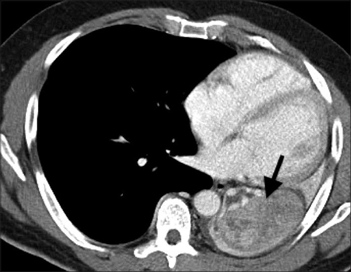 57-year-old man presenting with dyspnea and black-colored sputum diagnosed with endobronchial metastasis from melanoma. Contrast-enhanced axial CT image through the lower chest demonstrates heterogeneous enhancement of the left lower lobe mass (arrow).