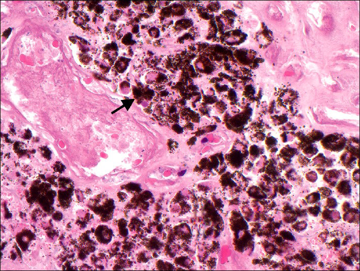 57-year-old man presenting with dyspnea and black-colored sputum diagnosed with endobronchial metastasis from melanoma. Microscopic findings: Staining of endobronchial biopsy specimen with hematoxylin and eosin shows pigment-laden cells, indicative of metastatic melanoma (×400).