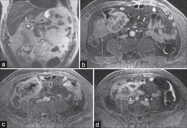 Cecal carcinoma incidentally discovered on MRI performed to evaluate a suspected post-cholecystectomy common hepatic duct injury in a 66-year-old man. (a) Coronal SSFSE and (b–d) three axial post-gadolinium 3D SPGR images demonstrate a nodular enhancing cecal mass (arrow) that involves the ileocecal valve. Several enlarged mesenteric pericecal nodes were negative for metastatic involvement at pathology. Note the paucity of signal inferiorly on the SSFSE image (a) which is a result of selecting the upper coil elements for an abdominal examination. There is improved signal-to-noise ratio for the 3D SPGR images (b–d) which had the appropriate coil selected.
