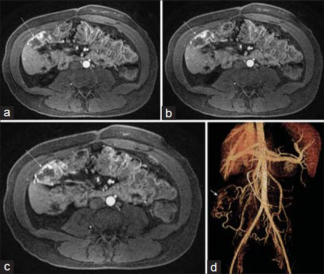 Arteriovenous malformation in the ascending colon in a 28-year-old woman with lower GI bleeding and chronic pancreatitis. (a–c) Post-gadolinium axial 3D SPGR images demonstrate serpiginous early arterial phase mural enhancement of a segment of the ascending colon (arrow). (d) Volume rendering from CT angiogram illustrates the malformation just inferior to the hepatic flexure with a feeding artery from the inferior mesenteric artery and a draining right colic vein.