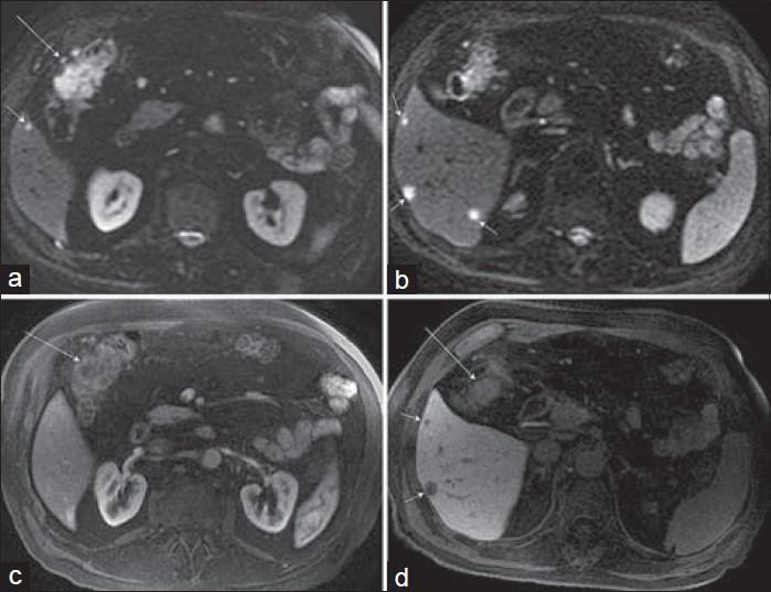 Hepatic flexure adenocarcinoma in a 74-year-old man that was discovered on routine colonoscopy. MRI was requested to screen for hepatic metastases, and a hepatobiliary contrast agent, gadoxetate disodium (Eovist), was used. a and b) Axial diffusion-weighted images (b = 800 s/mm2) demonstrate not only increased signal corresponding to a hepatic flexure mass (a, long arrow), but also multiple small hepatic metastases (short arrows) in the inferior right lobe. (c) Axial post-gadolinium arterial phase image demonstrates minimal enhancement of the colonic mass. (d) Hepatobiliary phase post-gadolinium axial image shows hypoenhancing hepatic metastases (short arrows) and partially visualized ill-defined hepatic flexure lesion (long arrow).