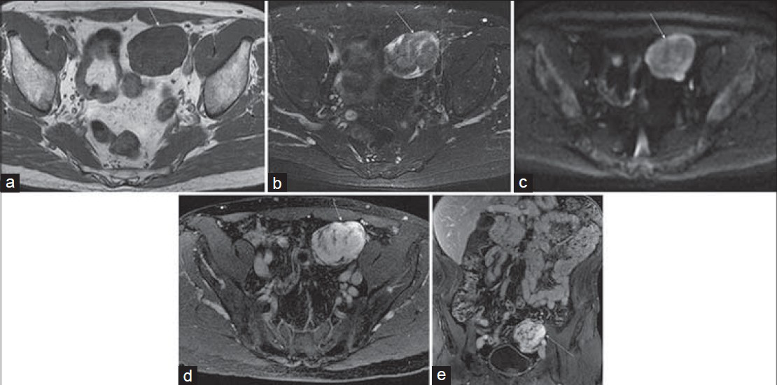 Sigmoid leiomyoma in a 65-year-old man with intermittent left lower quadrant pain that was thought to be due to urolithiasis. CT showed a pelvic mass and pelvic MRI was performed for further characterization. Axial (a) T1-weighted and (b) T2-weighted images show a well-circumscribed mass (arrow) with diffuse low T1 signal intensity and a whorled appearance on the T2-weighted image with central hypointensity. (c) Diffusion-weighted image (b = 800 s/mm2) (c, arrow) also demonstrates central low signal intensity with a hyperintense rim. Post-gadolinium 3D SPGR (d) axial and (e) coronal images show avid enhancement of the lesion.