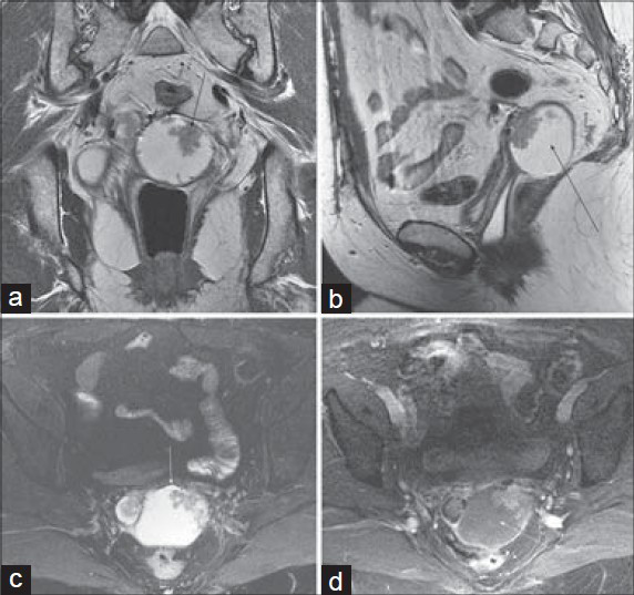 Ovarian cancer metastasis involving the sigmoid colon and vagina in a 56-year-old woman with a history of ovarian cancer. T2-weighted images without fat suppression in the (a) coronal and (b) sagittal planes and (c) fat-saturated T2-weighted image demonstrate a mixed solid cystic mass (arrow) in the pouch of Douglas just anterior to the sigmoid colon, with spiculation and tethering of the anterior margin of the sigmoid. (d) Axial post-gadolinium 3D SPGR image shows enhancement of the mural nodule within the metastasis, as well as stranding and tethering of the adjacent sigmoid colon.