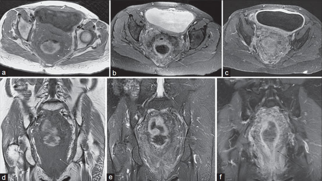 Perirectal plexiform neurofibroma in a 55-year-old woman with a history of pelvic radiotherapy for endometrial cancer and now presenting with fecal incontinence. (a) Axial T1-weighted, (b) T2-weighted, and (c) post-gadolinium 3D SPGR images show extensive non-obstructive soft tissue (arrow) surrounding the rectosigmoid colon. (d) Coronal T1-weighted, (e) T2-weighted, and (f) post-gadolinium 3D SPGR images again demonstrate the markedly decreased T1 signal intensity, as well as mildly increased T2 signal intensity and mild enhancement associated with the plexiform neurofibroma.