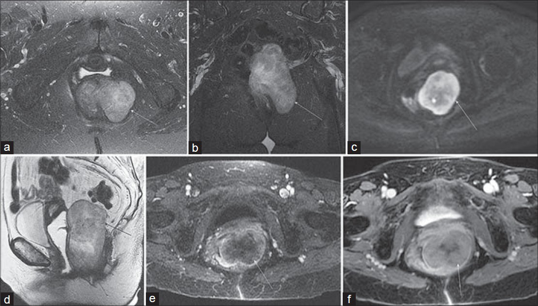 Rectal GIST in a 79-year-old woman with constipation and a palpable mass on rectal examination. Axial (a) fat-saturated T2-weighted and (b) diffusionweighted (b = 800 s/mm2) images demonstrate an exophytic mass (arrow) involving the left lateral wall of the rectum with mildly heterogeneous increased signal intensity. (c) Coronal fat-suppressed and (d) sagittal non–fat-saturated T2-weighted images again show the exophytic mass extending from the lateral rectal wall and abutting the posterior margin of the vagina. Axial (e) arterial phase and (f) delayed post-gadolinium 3D SPGR images reveal gradual internal enhancement of the lesion.