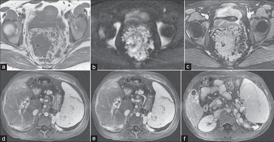 Rectal varices in a 29-year-old woman with hematochezia. Axial (a) T1-weighted, (b) diffusion-weighted (b = 600 s/mm2), and (c) fat-suppressed 2D b-SSFP images demonstrate diffuse nodular thickening of the rectum with surrounding serpiginous structures. (d–f) Axial portal venous phase post-gadolinium 3D SPGR images in the abdomen reveal chronic occlusion of the portal vein (arrow) with cavernous transformation (short arrow), splenomegaly, and perisplenic varices (short arrow).
