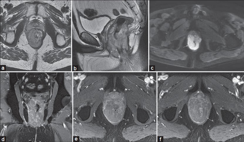 Rectal non-Hodgkin's lymphoma in a 42-year-old man with recent weight loss and change in bowel habits. T2-weighted (a) sagittal and (b and c) axial images, as well as diffusion-weighted (b = 600 s/mm2) images demonstrate a slightly asymmetric circumferential mass (arrow) with mildly heterogeneous intermediate signal intensity on T2-weighted images and diffuse hyperintensity on the diffusion-weighted image. (d) Coronal and (e and f) axial post-gadolinium 3D SPGR images show mildly heterogeneous hypoenhancement of the mass.