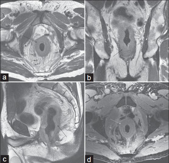 Metastatic involvement of rectum on MRI of the pelvis in a 73-year-old man with urothelial carcinoma of the bladder status post cytoprostatectomy. T2-weighted images in the (a) axial, (b) coronal, and (c) sagittal planes show diffuse circumferential soft tissue thickening of the rectum (arrow), as well as enlarged perirectal lymph nodes (short arrows). (d) Axial post-gadolinium 3D SPGR image (d) shows mild enhancement of the rectal wall.