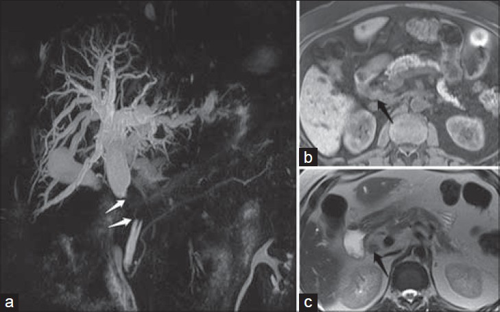 71-year-old male with obstructive jaundice secondary to CBD lymphoma. (a) Magnetic resonance cholangiopancreatography (MRCP) coronal projection demonstrate 2.3 cm tight stricture at the mid-CBD (white arrows) with severe upstream dilatation. (b and c) Non-contrast MRI upper abdomen axial T1- and T2-weighted images show circumferential mural thickening at the area of maximum stenosis with intermediate signal intensity (black arrows).