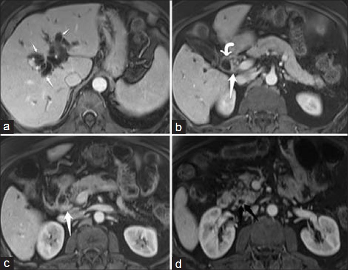 71-year-old male with obstructive jaundice secondary to CBD lymphoma. Contrast-enhanced MRI with axial post-contrast T1-weighted images at different levels: (a) at the level of the hepatic duct bifurcation, shows severe bilobar intrahepatic biliary dilatation (short white arrows); (b) at the level of the junction of the markedly dilated proximal CBD (curved white arrow) and the stenotic segment (straight white arrow); (c) at the level of mid-CBD stricture show that the lesion enhances homogeneously (white arrow); (d) at the level of distal CBD shows the normal caliber of the CBD within the pancreatic head (black arrow).