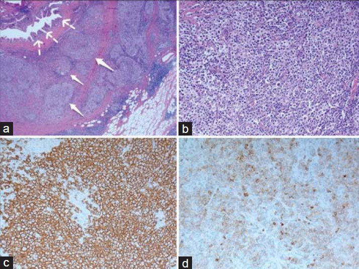 Histological sections stained with hematoxylin and eosin (H and E) (a) low-power view, (×25) shows nodules of lymphoid cells (white arrows) surrounding the common bile duct (dotted white arrows). (b) medium-power view, (×200) shows the nodules with a mix of neoplastic centrocytes and centroblasts. Immunochemical tests (c) shows the neoplastic lymphoid cells are positive for CD20 marker and (d) the cells are positive for CD10 marker.