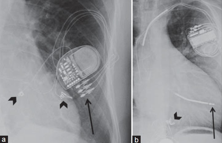 Lead components and fixation mechanisms. X-ray (a) PA view shows helical epicardial lead tips actively fixed and sutured to the epimyocardium (black arrowheads). Image also shows a Pulse generator (G) with lead terminal connector pins engaged on the generator connector block (black arrow). (b) LAT view shows ICD and pacemaker combination with ICD lead tip passively fixed on the heart trabeculae (black arrow). Note the epicardial pacemaker with the helical lead tips actively fixed (black arrowhead).