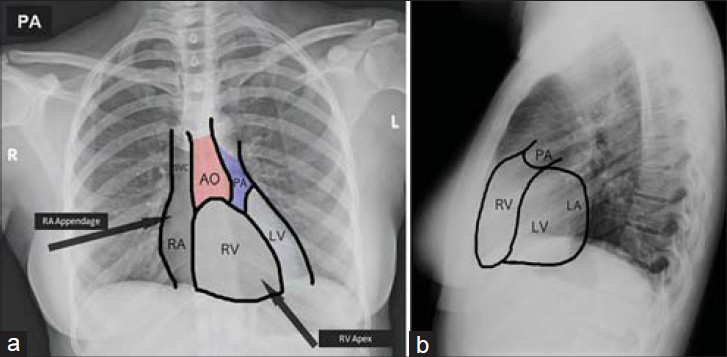 Normal chest PA and LAT radiographic views. Chest X-ray (a) posterio-anterior (PA) view and (b) lateral (LAT) view of normal cardiac anatomy shows the aorta (AO), pulmonary artery (PA), right ventricle (RV), left ventricle (LV), and right atrium (RA).