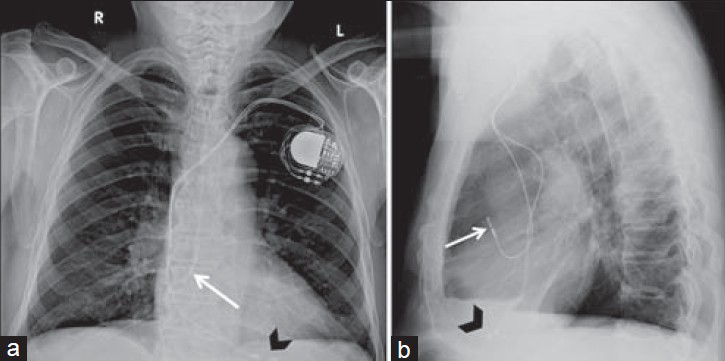 Dual-chamber pacemaker. 89-year-old male with a dual-chamber pacemaker placed via the left subclavian vein with the generator in the subcutaneous left infraclavicular fossa. Chest X-ray (a) PA view and (b) LAT view show the right atrial lead is inferiorly directed and takes a “J loop” curve with tip pacing the right atrial appendage (white arrow). Right ventricle lead directed inferiorly through the right atrium and tricuspid valve, then courses anteriorly and inferiorly with the tip at the right ventricular apex (black arrowhead). In single-chamber pacemakers, only the right atrial or ventricular lead is present.