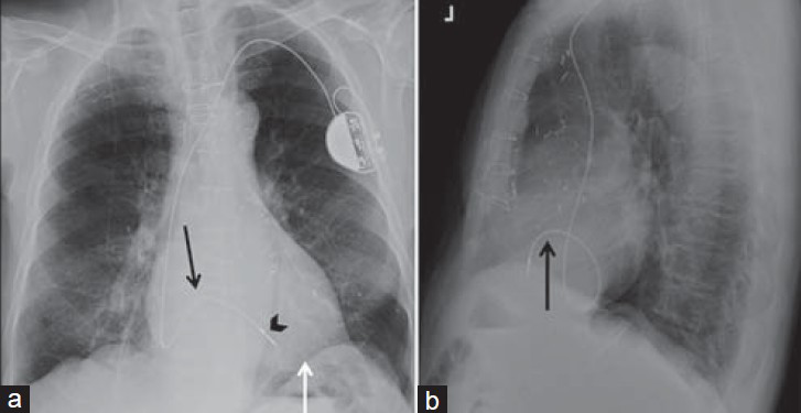 Single-chamber pacemaker with abnormal position of the lead. 73-year-old male with a single-chamber pacemaker placed using the subclavian transvenous approach with an abnormally positioned lead. Chest X-ray (a) PA view shows the lead is directed inferiorly through the right atrium taking a serpentine course (black arrow) through the coronary sinus with lead tip misplaced in an epicardial vein (black arrowhead) instead of the right ventricular apex (white arrow). Lead tip is passively fixed and pulse generator is placed in a subcutaneous pocket in the infraclavicular fossa. (b) Lateral view confirms lead misplacement with lead curving in a loop and then coursing anteriorly (black arrow) instead of descending and coursing anteriorly as would be seen in with a correctly placed right ventricular lead.