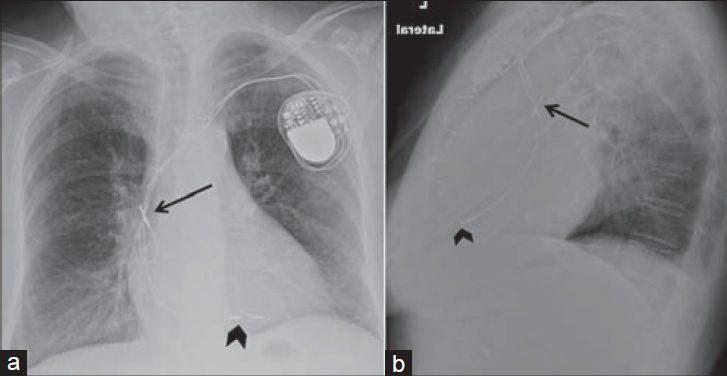 Unsatisfactory right atrium lead position. 80-year-old female with a dual-chamber pacemaker placed via the subclavian vein approach. Chest X-ray (a) PA view shows the right atrial lead curls upward and crosses itself, with the tip unsatisfactorily positioned in the superior vena cava (black arrow) instead of taking a “J loop” course toward the right atrial appendage. Right ventricular lead correctly placed (black arrowhead), directed inferiorly through the right atrium and tricuspid valve, and courses anteriorly and inferiorly to the left of the spine, with the tip at the right ventricular apex. (b) LAT view shows right ventricular lead courses anteriorly ending at the right ventricular apex (black arrowhead). Right atrial lead curls upward with the tip misplaced in the superior vena cava (black arrow).