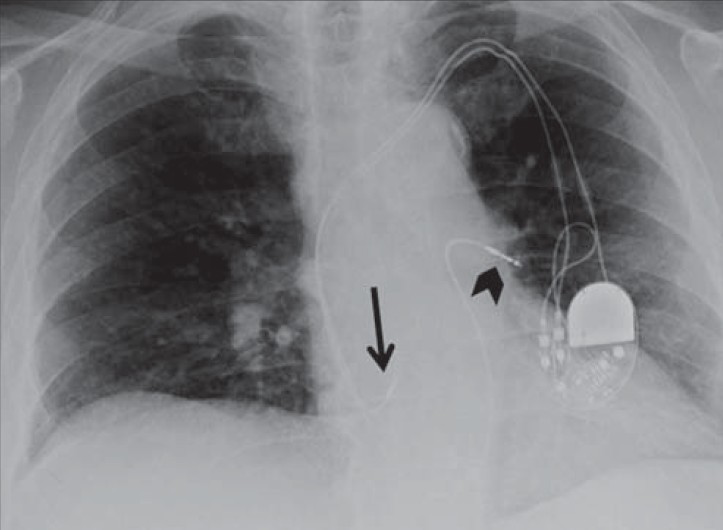 Right ventricle lead in left main pulmonary artery. 73-year-old male with a dual-chamber pacemaker. Chest X-ray PA view shows the right ventricle lead is misplaced (black arrowhead), taking a “swan ganz”-like course and ending in the left main pulmonary artery instead of the right ventricle apex. Right atrium lead is correctly placed at the right atrial appendage (black arrow).