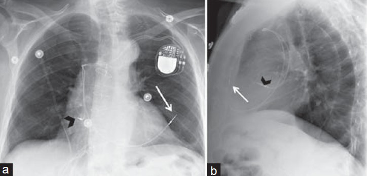 Inadvertent lead placement. Chest X-ray (a) PA and (b) LAT views of a dual-chamber pacemaker show where the right ventricular lead has inadvertently perforated the right ventricular wall, causing the lead tip to lie outside the cardiac chambers, within the anterior thoracic cavity (white arrow) and right atrial lead with the tip correctly placed in the right atrial appendage (black arrowhead).