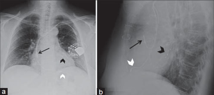 Biventricular pacemaker. 71-year-old female with a biventricular pacemaker with leads placed via transvenous approach with the generator in a subcutaneous pocket in the infraclavicular fossa. Chest X-ray (a) PA view shows the right atrial lead correctly placed at the right atrial appendage (black arrow) with “J loop” appearance. Right ventricular lead correctly placed at the apex (white arrowhead), seen left of the spine. Left ventricle lead, directed inferiorly through the right atrium, takes a serpentine course via the coronary sinus (black arrowhead) with the tip in a posterolateral epicardial vein of the left ventricular wall. (b) LAT view shows anteriorly and superiorly oriented right atrial lead (black arrow) and an anteriorly and inferiorly directed right ventricular lead (white arrowhead). Left ventricular lead correct position is confirmed with the posterior course of lead (black arrowhead) on LAT view.