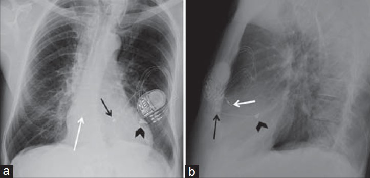 Biventricular pacemaker with epicardial leads. 66-year-old female with a biventricular pacemaker with epicardial leads placed using a transthoracic approach with the generator lodged in the subcutaneous tissues of the left anterior chest wall. Chest X-ray (a) PA view and (b) LAT view show epicardial leads are sutured to the epimyocardium on the right ventricle (black arrow) and left ventricle (black arrowhead). A right atrial lead is also present (white arrow).