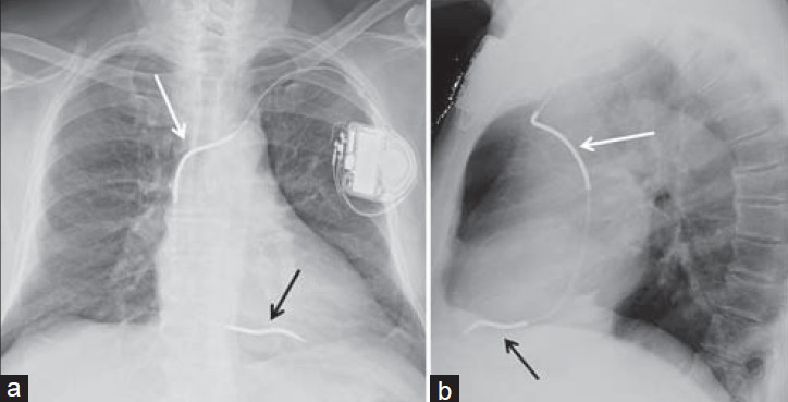 Correct ICD position. 73-year-old female with an ICD, chest X-ray (a) PA view shows proximal shock coil located at the left brachiocephalic– superior vena cava junction (white arrow), while distant shock coil is at the right ventricular apex (black arrow). (b) Lateral view shows proximal shock coil (white arrow), and since the lead courses anteriorly and inferiorly, distal shock coils confirmed at the right ventricle apex (black arrow).