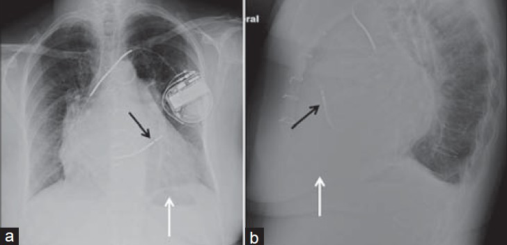 Right ventricular outflow tract (RVOT) ICD position. 69-year-old female with ICD chest X-ray (a) PA and (b) LAT views show distal shock coil located at the right ventricular outflow tract (black arrow) instead of the right ventricular apex (white arrow). Lateral view confirms that the lead, by taking an anterior and superior course, is placed in the RVOT (black arrow) and not in the right ventricle apex (white arrow).