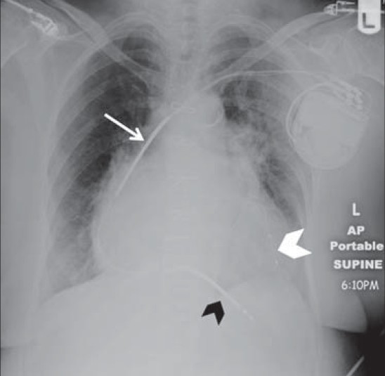 Corrected ICD in 69-year-old female seen in Figure 11. Chest X-ray AP view shows distal shock coil originally placed in the right ventricular outflow tract, but was later repositioned to achieve better defibrillation threshold. Shock coils are correctly placed at the superior vena cava (white arrow) and the right ventricle apex (black arrowhead). A left ventricle lead via the coronary sinus has been placed in the interval (white arrowhead).