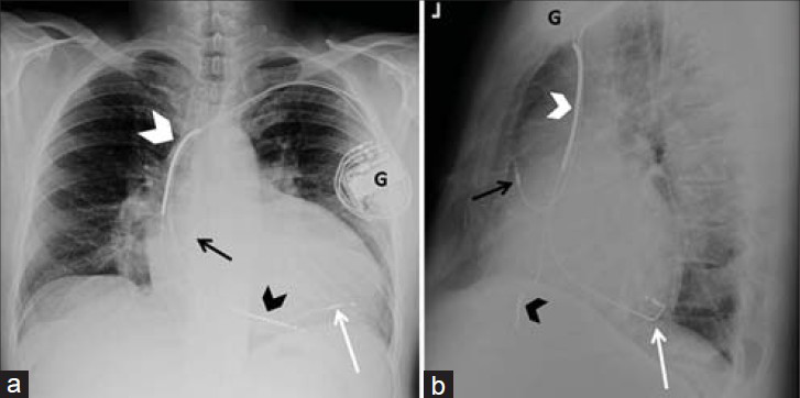 ICD and CRT combination. 52-year-old male with an implantable cardioverter defibrillator combined with cardiac resynchronization therapy. Chest X-ray (a) PA and (b) LAT views show the leads are placed via the subclavian vein with the generator (G) in a subcutaneous pocket in the infraclavicular fossa. The image shows ICD lead with shock coils at the brachiocephalic–superior vena cava junction (white arrowhead) and the right ventricle (black arrowhead). Pacemaker leads are correctly placed in the right atrial appendage (black arrow) and left ventricle (white arrow), the latter through the coronary sinus and the epicardiac vein.