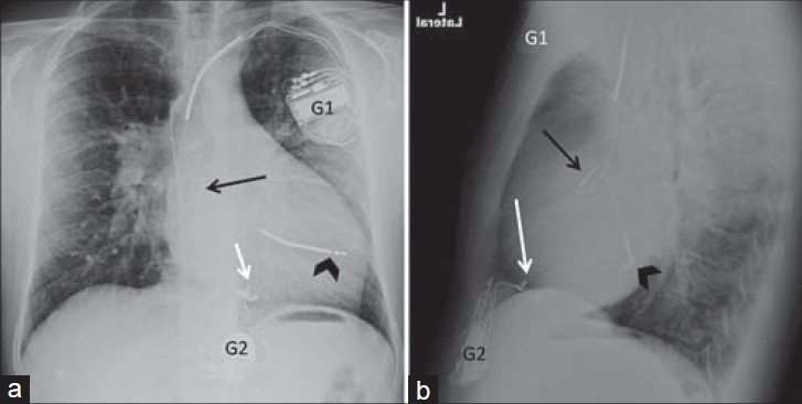 Biventricular pacing with ICD and two generators. 35-year-old male with complex congenital heart disease. Chest X-ray (a) PA and (b) LAT views show an ICD (black arrowhead) in the left ventricle through an atrial baffle and a right atrial lead (black arrow), both via the left subclavian venous approach with generator (G1) in the left infraclavicular fossa. A second generator in the epigastrium (G2) has epicardal leads (white arrow) to the right ventricle through the subxiphoid approach.