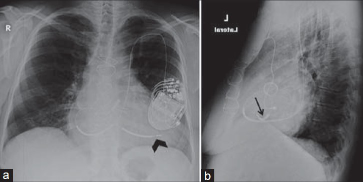 ICD via left subclavian vein and epicardial lead. 44-year-old female with an ICD. (a) Chest X-ray PA view shows an ICD inserted via the left superior vena cava directed to the right ventricle (black arrowhead) through the coronary sinus and the right atrium. (b) LAT view shows a transthoracic epicardial lead to the left ventricle (black arrow).