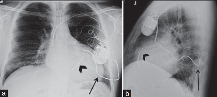 Subcutaneous array and unsatisfactory ICD position. 51-year-old male with an ICD. Chest X-ray (a) PA and (b) LAT views show the ICD with distal shock coil in the right ventricle outflow tract (black arrowhead). This patient also has a subcutaneous array in the left chest wall (black arrow), which incorporates more of the ventricular wall into the shock focus, improving the defibrillation threshold.