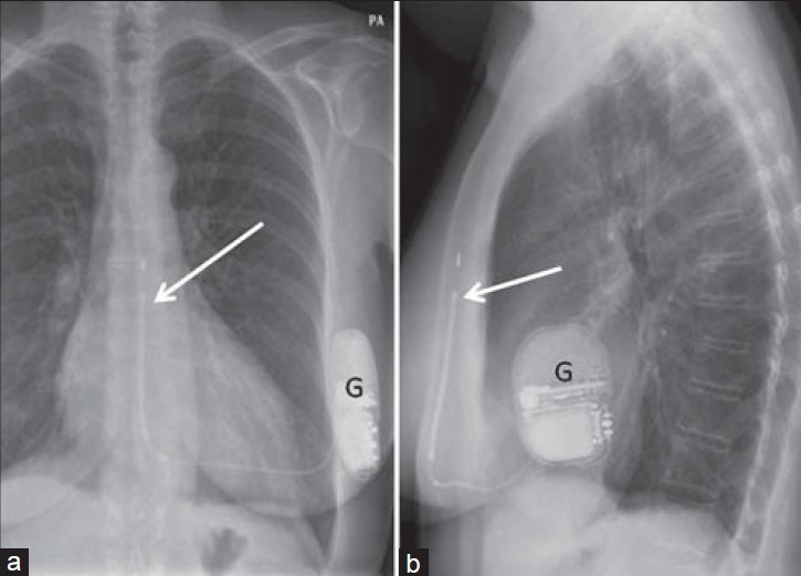 Subcutaneous ICD. 48-year-old female with a subcutaneous ICD. Chest X-ray (a) PA and (b) LAT views of an S-ICD[8] show the pulse generator (G) is implanted close to the left mid-axillary line. The subcutaneous lead, containing sensing electrodes and shock coils, is placed on average 1.5 cm to the left of the mid-sternal line (white arrow). Images courtesy of Juan C. Sotomonte, MD.