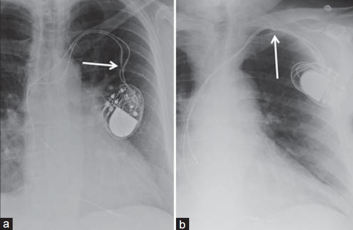 Malfunctioning leads. (a) 56-year-old female with a dual-chamber malfunctioning pacemaker. Chest X-ray PA view shows the pacemaker malfunction is due to a kinked lead (white arrow). (b) 86-year-old male with a malfunctioning dual-chamber pacemaker. Chest X-ray AP view shows malfunction is due to pinching of the lead (white arrow) before entering the subclavian vein by the clavicle.