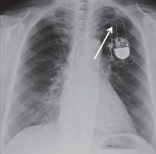 Complete lead fracture. PA chest X-ray of a malfunctioning pacemaker due to lead complete fracture shows discontinuation of the lead wire (white arrow) proximal to the generator with wide gaps among the lead segments representing dislodgement and migration.