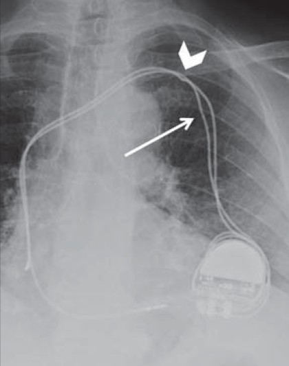 Pinched lead and “incomplete” lead fracture. 84-year-old female with a malfunctioning dual-chamber pacemaker. Chest X-ray PA view shows pacemaker malfunction is due to pinching of lead wire by the clavicle (white arrowhead). The relative thinning of caliber of the other lead (white arrow) simulates an incomplete fracture, but is in fact caused by the tie-down, which affixes the lead to the chest wall.