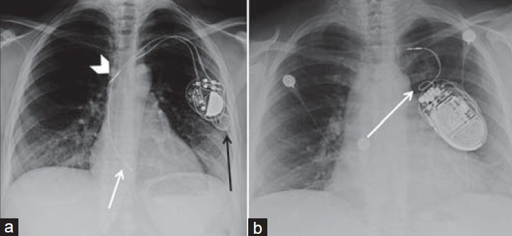 Twiddler syndrome. (a) 29-year-old female with a dual-chamber pacemaker with twiddler syndrome. Chest X-ray PA view shows the generator has been rotated by the patient causing the lead wires to dislodge and wind around the generator (black arrow). The right atrial lead (white arrowhead) has been removed from the right atrial appendage and lies in the superior vena cava and the right ventricular lead (white arrow) now lies within the right atrium. (b) 54-year-old female with single-chamber pacemaker and a severe case of twiddler syndrome. Chest X-ray PA view shows the lead wire has been completely reeled around the generator (white arrow) causing the patient to receive no cardiac electrical therapy.