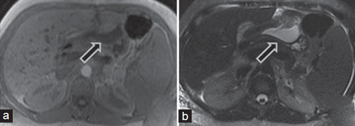 35-year-old woman underwent orthotopic liver transplantation for autoimmune hepatitis-induced cirrhosis associated with secondary portal hypertension and was diagnosed with postoperative biliary anastomotic leakage. Corresponding axial (a) T1-weighted and (b) T2-weighted sequences of the upper abdomen show left perihepatic fluid collection (arrow) with a low T1 signal and high T2 signal.