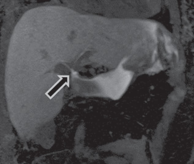 35-year old woman underwent orthotopic liver transplantation for autoimmune hepatitis-induced cirrhosis associated with secondary portal hypertension and was diagnosed with postoperative biliary anastomotic leakage. Coronal T1 MIP image 45 min post-Primovist injection shows high T1 signal bile pooling from biliary tree at the anastomotic site (arrow) and within the left perihepatic and subphrenic spaces.