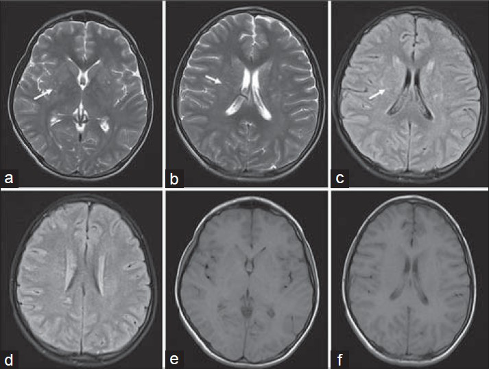 16-year-old boy presented with altered sensorium of 1 day duration diagnosed with eosinophilic meningitis caused by A. cantonensis. MR images, (a and b) axial T2 (c and d) axial FLAIR images, at the basal ganglia level demonstrate subtle scattered hyperintensities in the periventricular regions (white arrows). (e and f) Axial T1-weighted images do not show these features.