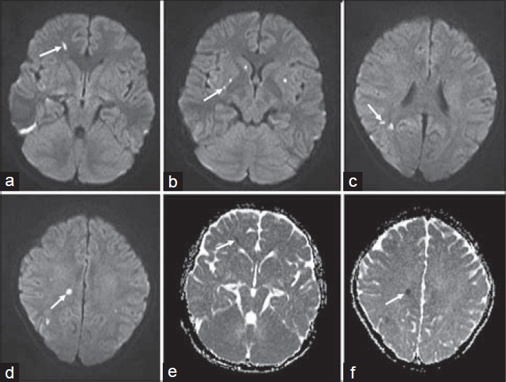 16-year-old boy presented with altered sensorium of 1 day duration diagnosed with eosinophilic meningitis caused by A. cantonensis. (a–d) MR diffusion-weighted images show foci of restricted diffusion appearing bright (white arrows). (e and f) Apparent diffusion coefficient (ADC) series shows hypointense areas (white arrows).