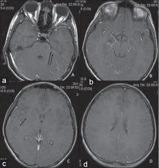 16-year-old boy presented with altered sensorium of 1 day duration diagnosed with eosinophilic meningitis caused by A. cantonensis. (a–d) MR post-gadolinium contrast-enhanced T1WI images show subtle meningeal enhancement (double black arrows) and faint enhancement of the lesions in the basal ganglia (single black arrow).